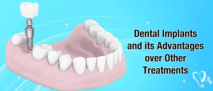 What are dental implant advantages? - pure titanium