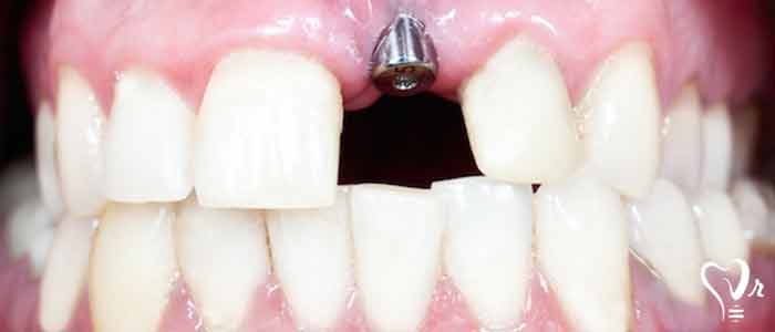 tooth decay