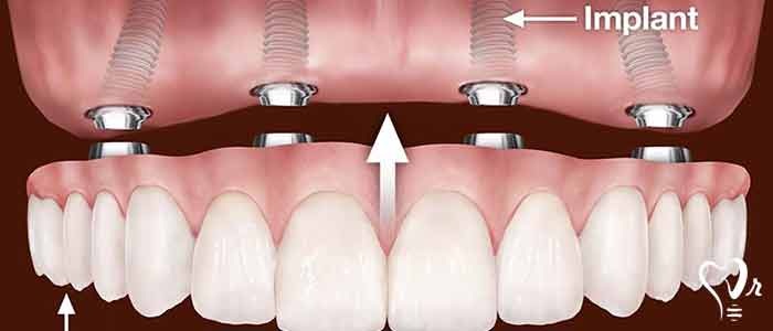implant restoration