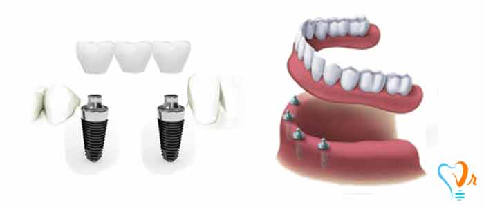 Surgeon’s duties before starting implant treatment: