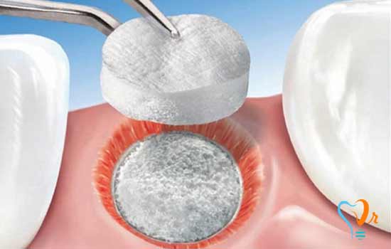 Bone Graft 