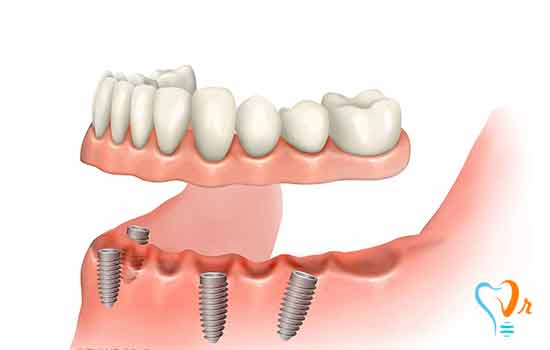 The people with some type of diseases that are not good candidates for implant