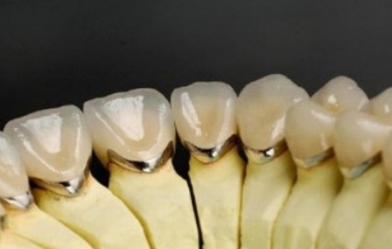 Types of dental coverings PFM