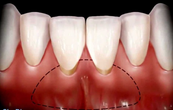 Gingival Surgery
